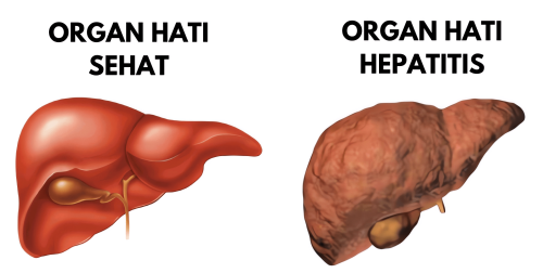 perbedaan hati sehat & hepatitis (2)-min